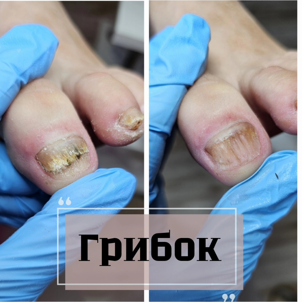 обработка грибковых ногтей (стоимость указана за 10 полностью пораженных )