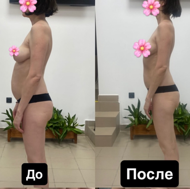 Послеродовое восстановление ( на фото результат с 1-ого раза) - 1